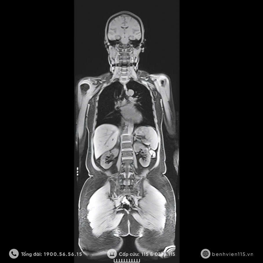Hình ảnh cộng hường từ toàn thân trên máy MRI 3.0 Tesla