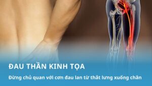 đau thần kinh tọa