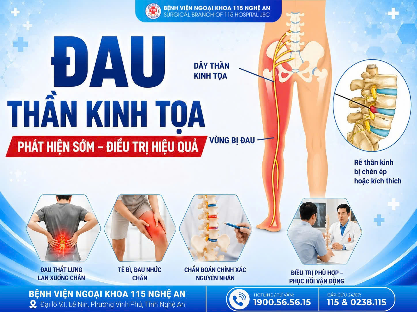 Đau thần kinh tọa 